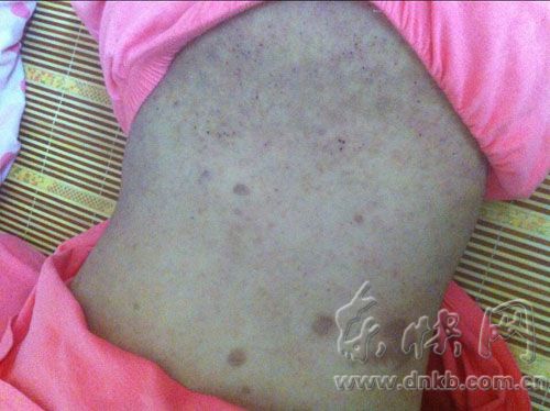 21歲患怪病女孩盼見親生父母　只剩一年左右壽命