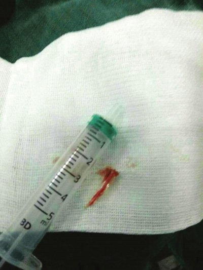 六旬男子硬吞下兩根魚刺　刺穿心臟主動脈險喪命