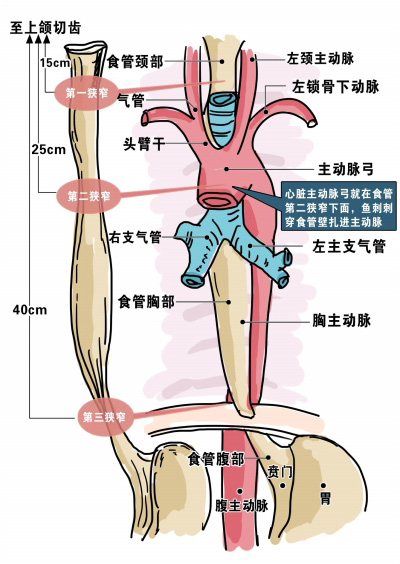 六旬男子硬吞下兩根魚刺 刺穿心臟主動脈險喪命