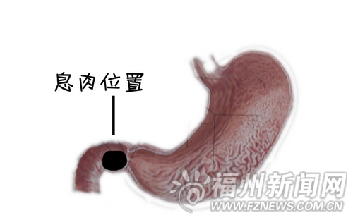新娘婚宴上暴飲暴食　腸道息肉長大“大肚”難消
