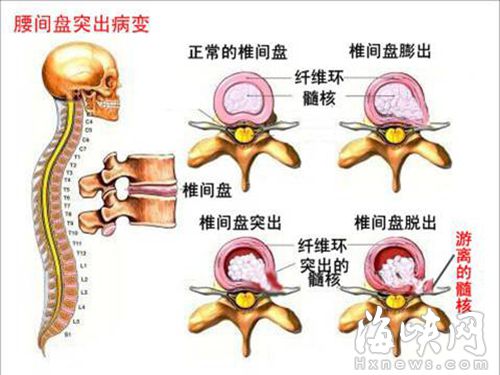 椎間盤突出病變圖（資料圖）