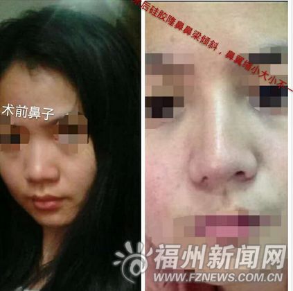 妙齡女整容后鼻孔一大一小　被醫院告知無法修復