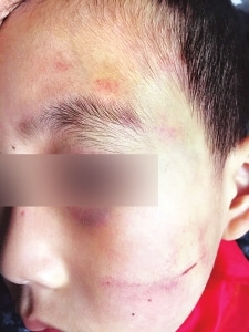11歲男童作業不會做　遭校長體罰致臉部多處淤青