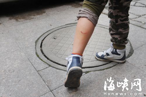 9歲男童給流浪狗喂食　小腿被5條狗咬得鮮血直流