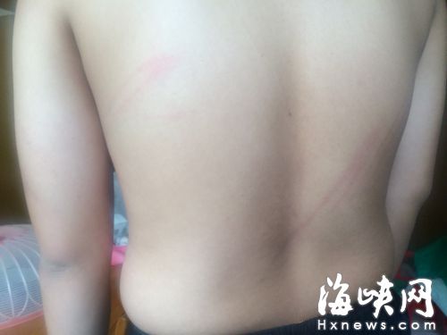 小凱背部有多處傷痕