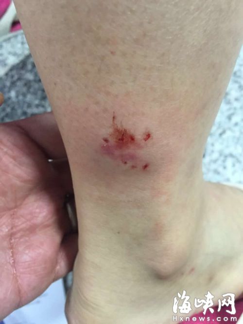 林女士小腿被惡狗狠狠咬了一口，留下7個牙印