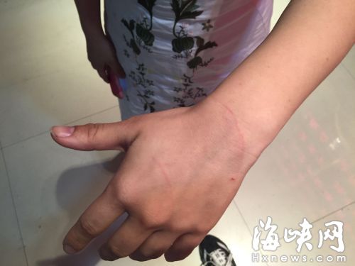 林女士的手和手臂有多道抓痕（當事人供圖）