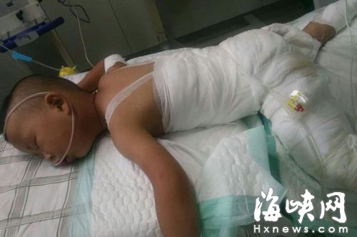 3歲小朋友背部被辣椒水大面積重度燙傷