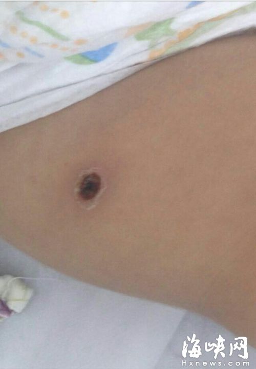 女嬰被恙蟲叮咬高燒險喪命　搶救半個月脫離危險