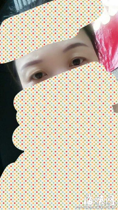 張女士術前術后不同的照片