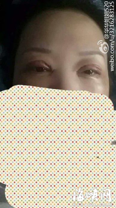 張女士術前術后不同的照片