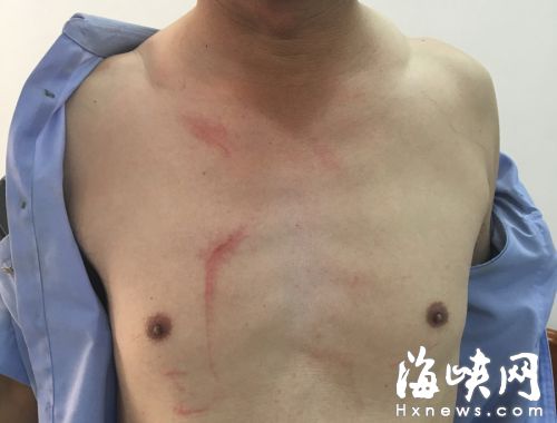 民警胸口多處被抓傷