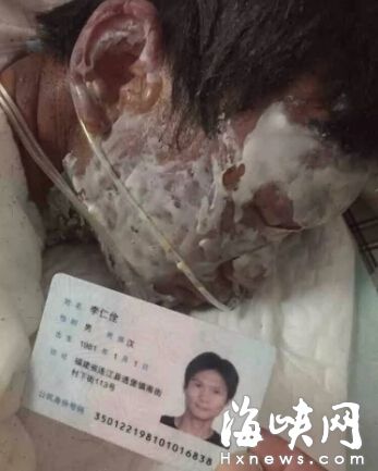 李仁佺被嚴重燒傷