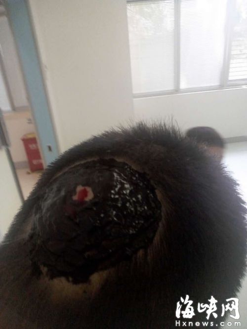  男子頭皮被馬蜂扯掉一塊，留下一塊血疤